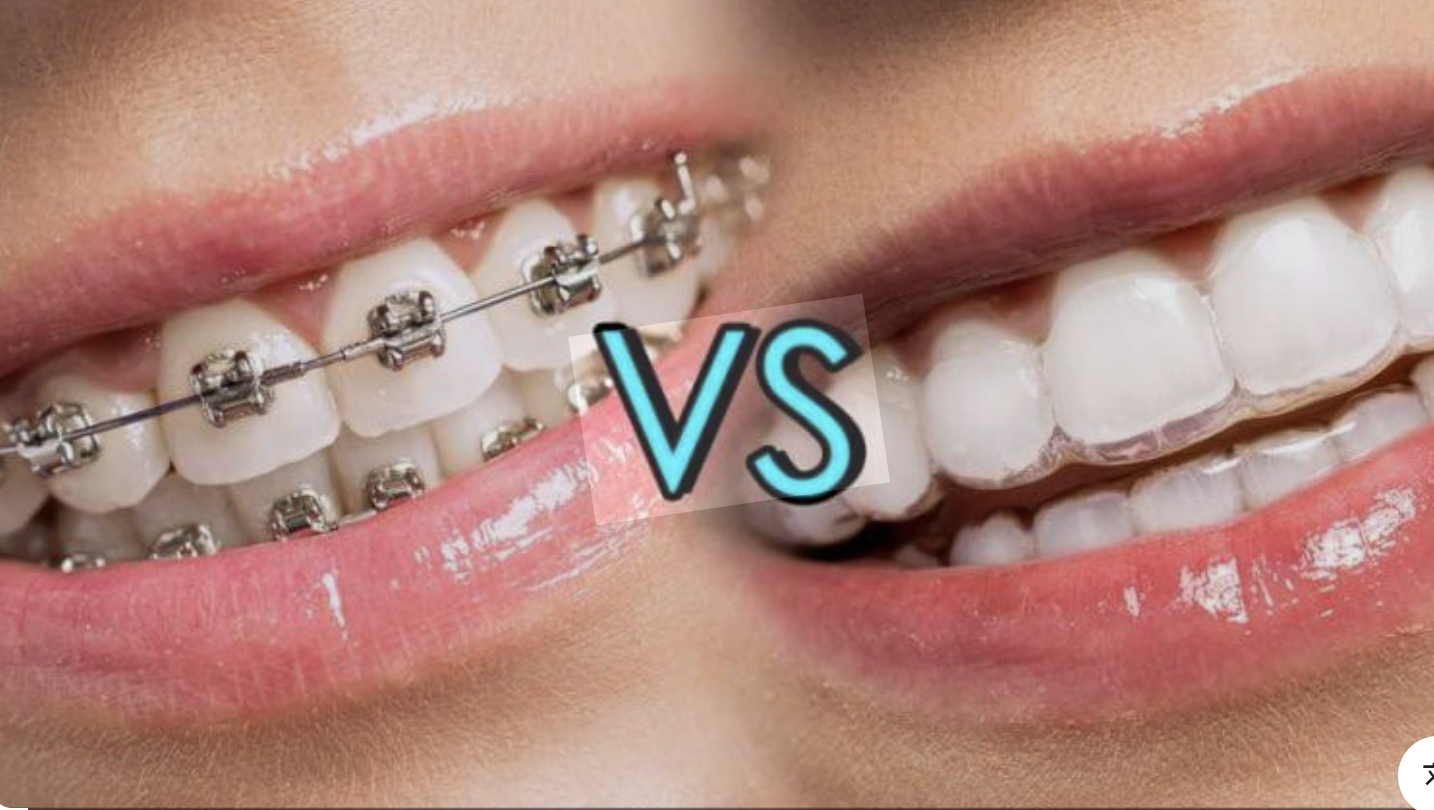 传统牙套 vs 隐适美：哪种矫正方式更适合您？